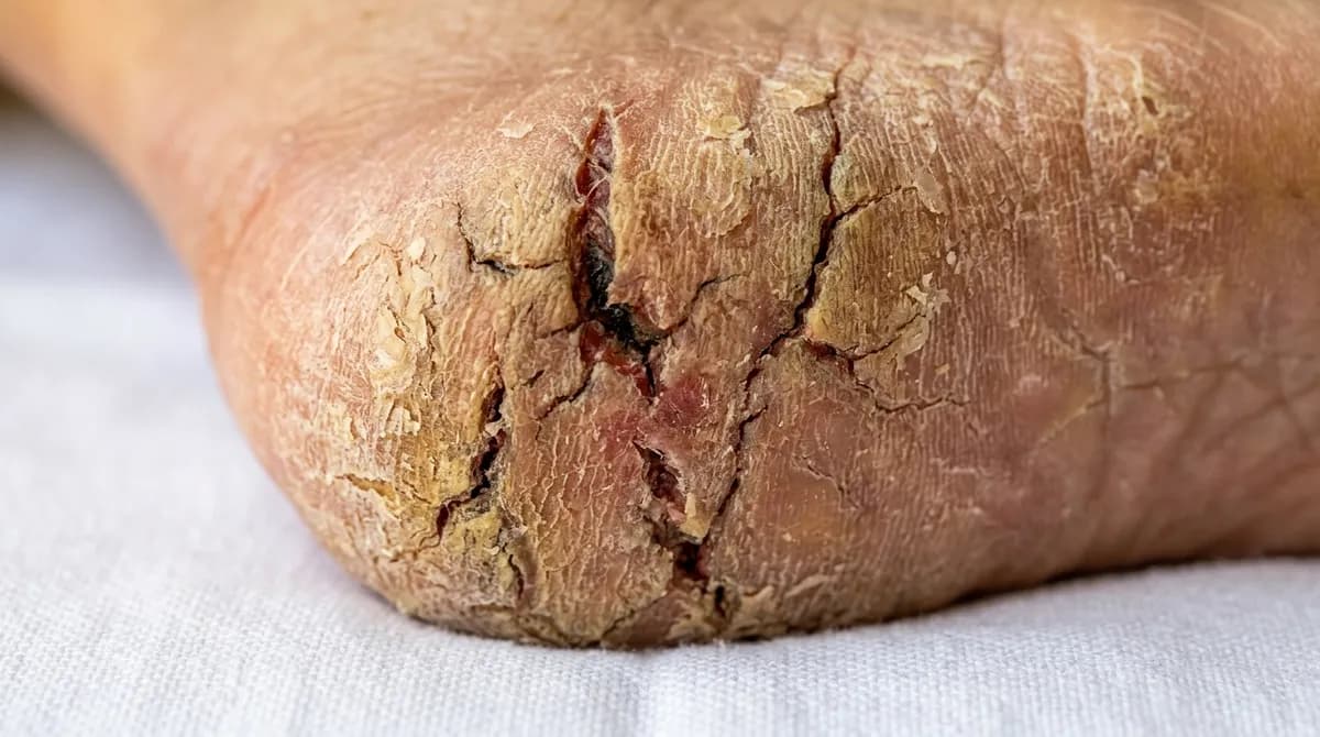 Extreme close-up of severely cracked dry heel skin