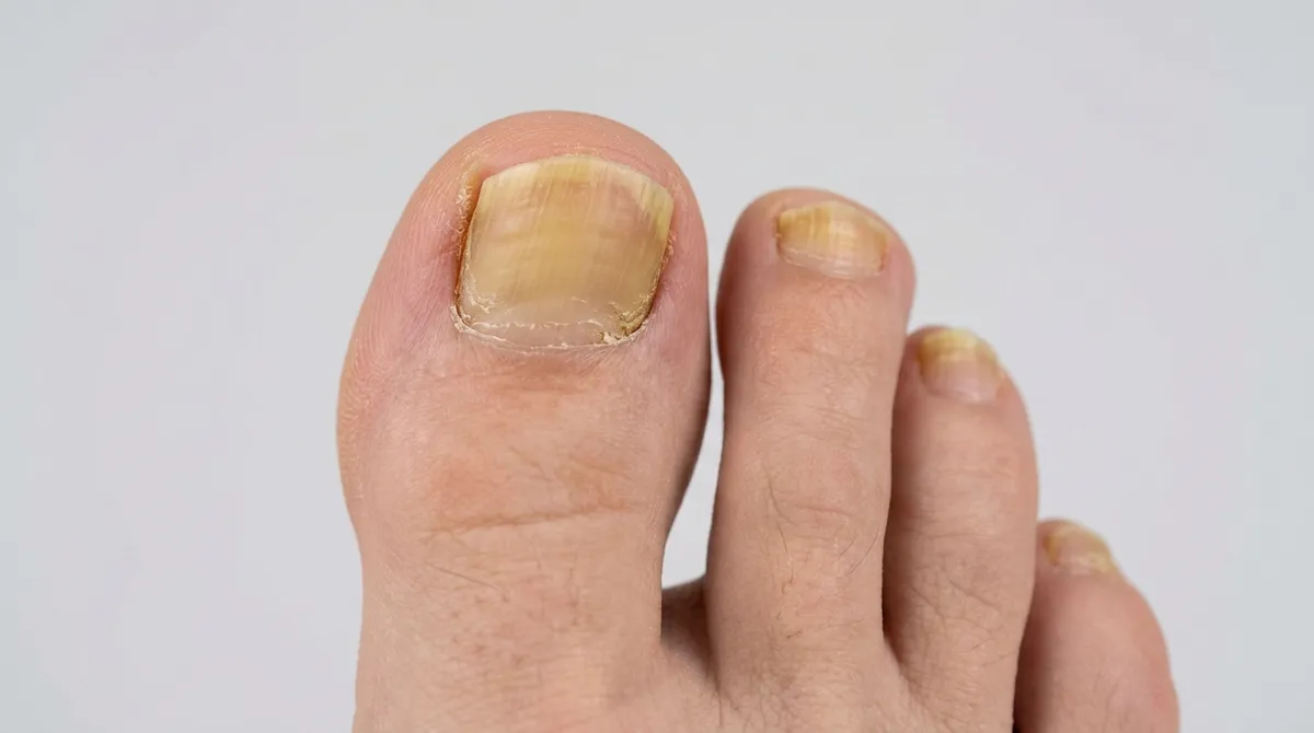 Toenails affected by persistent fungal infection